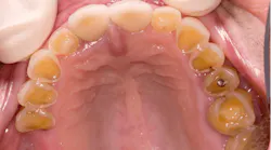 Figure 2: Dental erosion periomolysi