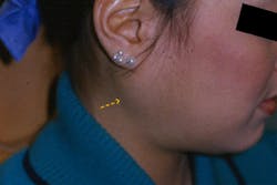 Figure 3: Salivary gland enlargement sialdenosis Figure 3: Salivary gland enlargement sialdenosis