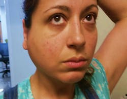 Figure 4a: Sialdenosis Figure 4a: Sialdenosis