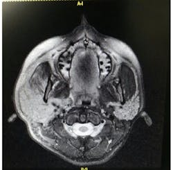 Figure 4b. Sialdenosis CBCT Figure 4b. Sialdenosis CBCT