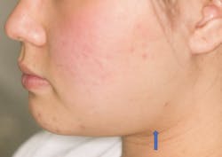 Figure 5: Sialidenosis Figure 5: Sialidenosis