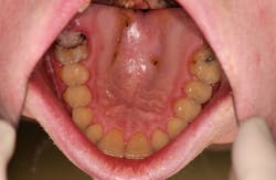 Figure 6: Discolored teeth, dental caries, palatal mucosal abrasion Figure 6: Discolored teeth, dental caries, palatal mucosal abrasion