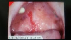 Figure 7: Traumatic lesion BN Figure 7: Traumatic lesion BN