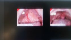 Figure 8: Abrasion, inflammation, erythema BN Figure 8: Abrasion, inflammation, erythema BN