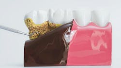 model of teeth showing bone loss model of teeth showing bone loss