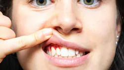 woman holding her lip up with one finger showing her bleeding gums