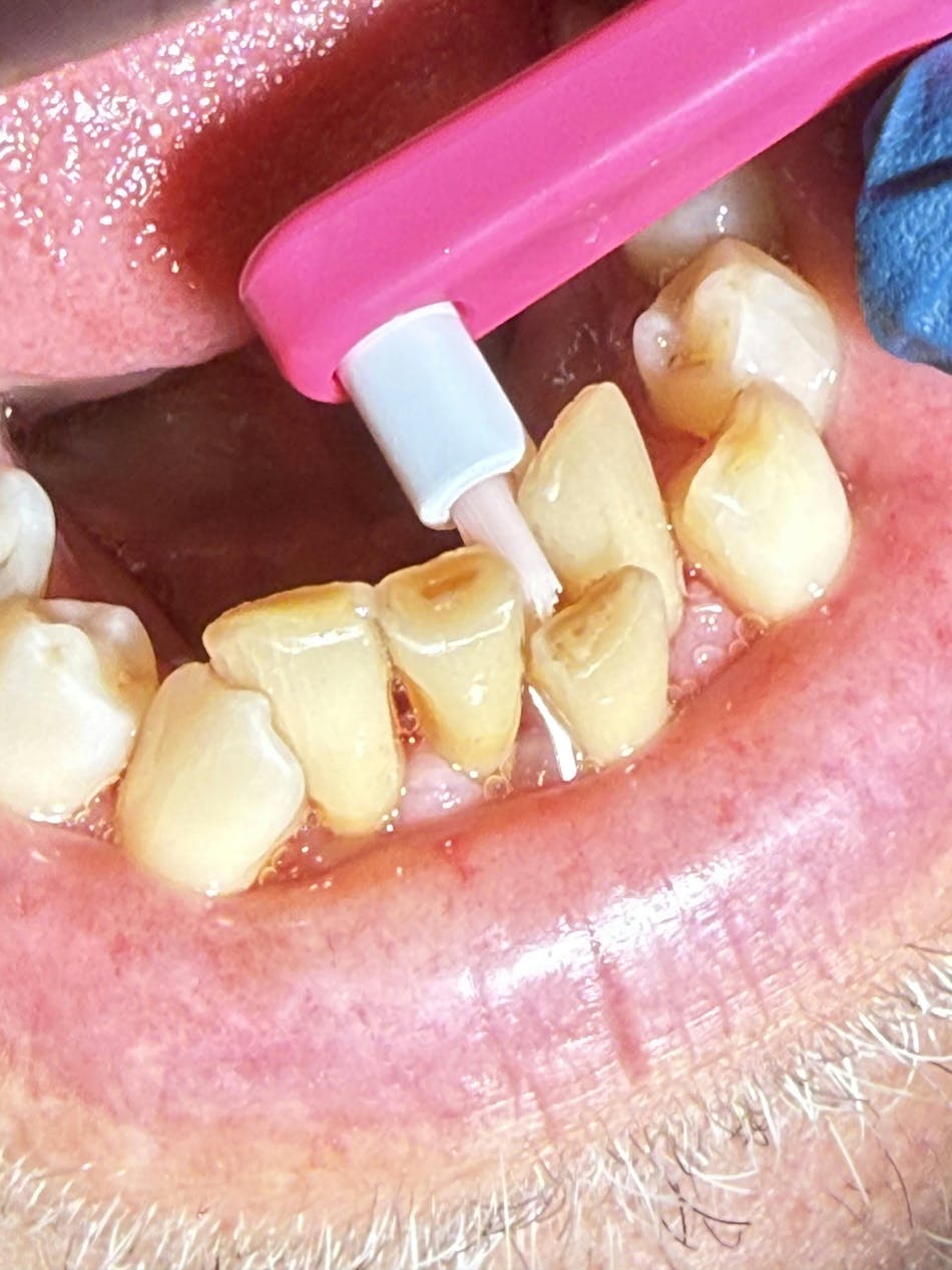 End tuft for lower anterior: Small, precise end-tuft brush reaching areas of severe crowding End tuft for lower anterior: Small, precise end-tuft brush reaching areas of severe crowding