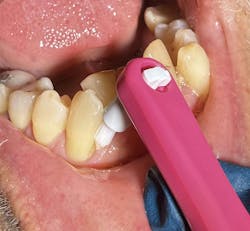 End tuft around canine: Intentional strokes with the end-tuft brush along elongated gumline that is often missed with traditional brushing and flossing End tuft around canine: Intentional strokes with the end-tuft brush along elongated gumline that is often missed with traditional brushing and flossing