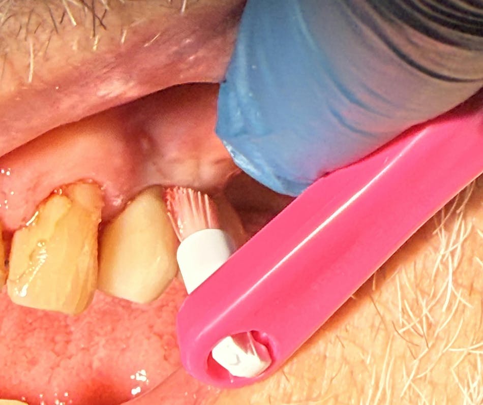 End tuft around implant: Tapered precise bristles reach subgingivally around the unique pocketing of dental implants End tuft around implant: Tapered precise bristles reach subgingivally around the unique pocketing of dental implants