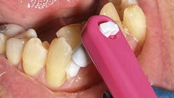 end-tuft brush can get around the gumline better than traditional toothbrushes end-tuft brush can get around the gumline better than traditional toothbrushes