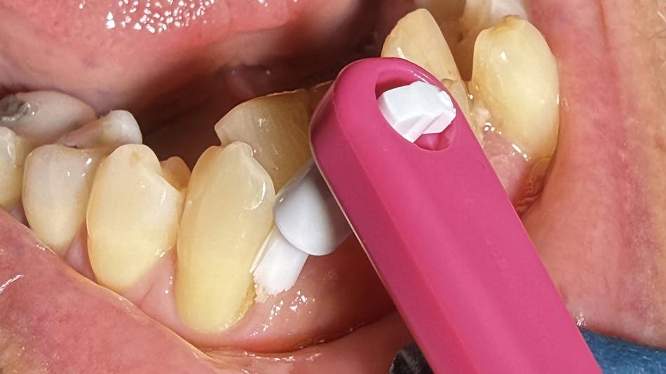 end-tuft brush can get around the gumline better than traditional toothbrushes end-tuft brush can get around the gumline better than traditional toothbrushes