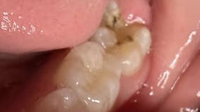 teeth after application of silver diamine fluroide