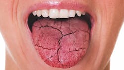 cracked tongue sticking out denoting dry mouth cracked tongue sticking out denoting dry mouth