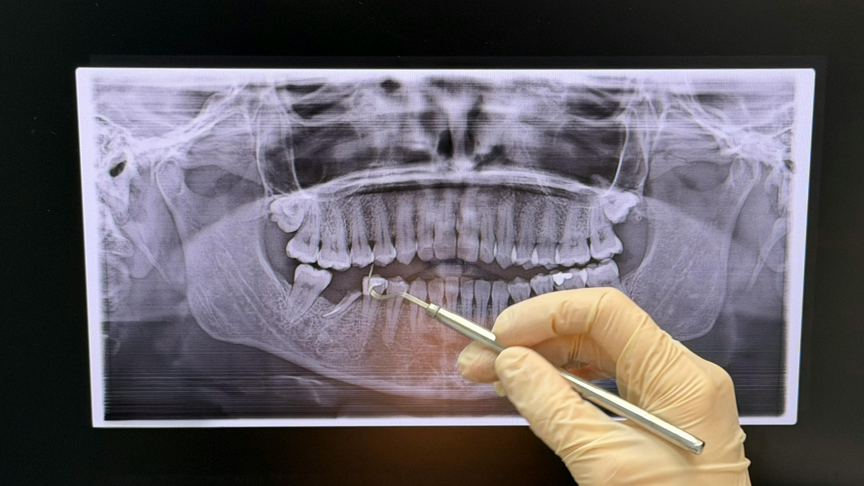 dental radiograph