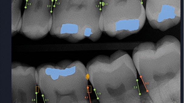 AI imaging software of teeth