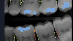 AI imaging software of teeth AI imaging software of teeth