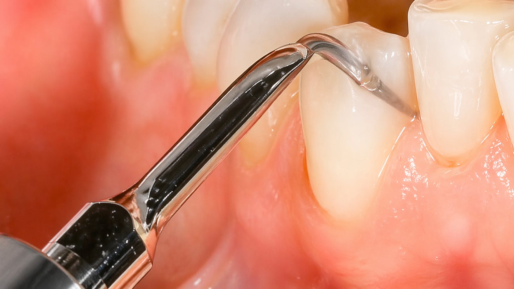 using an ultrasonic dental instrument