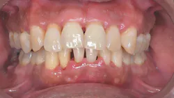 periodontal disease periodontal disease
