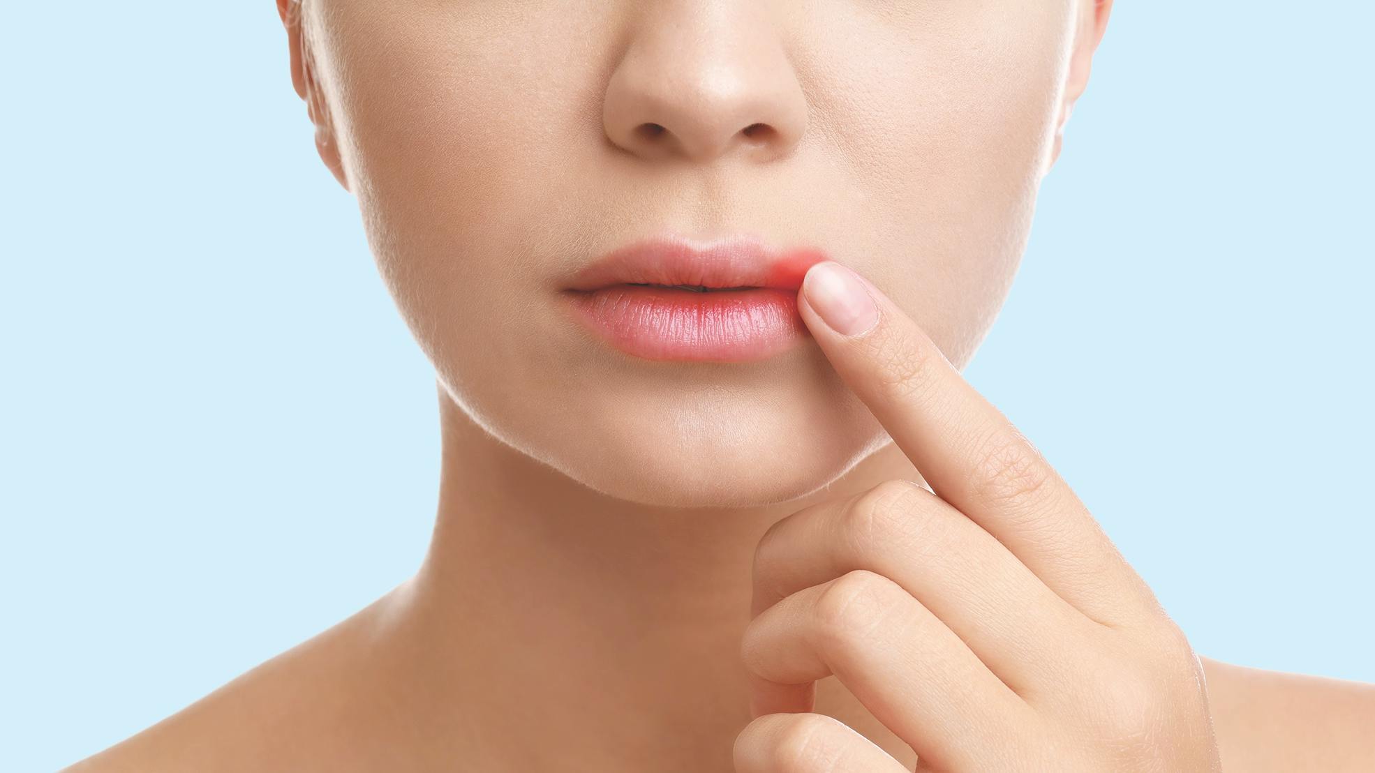 woman pointing out a sore on her mouth