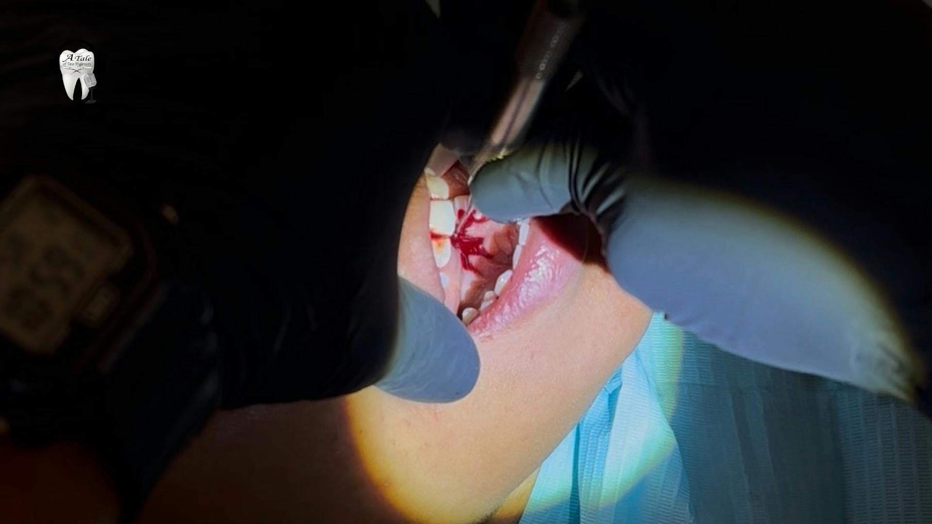 dental-hygienist-hand-instrumentation