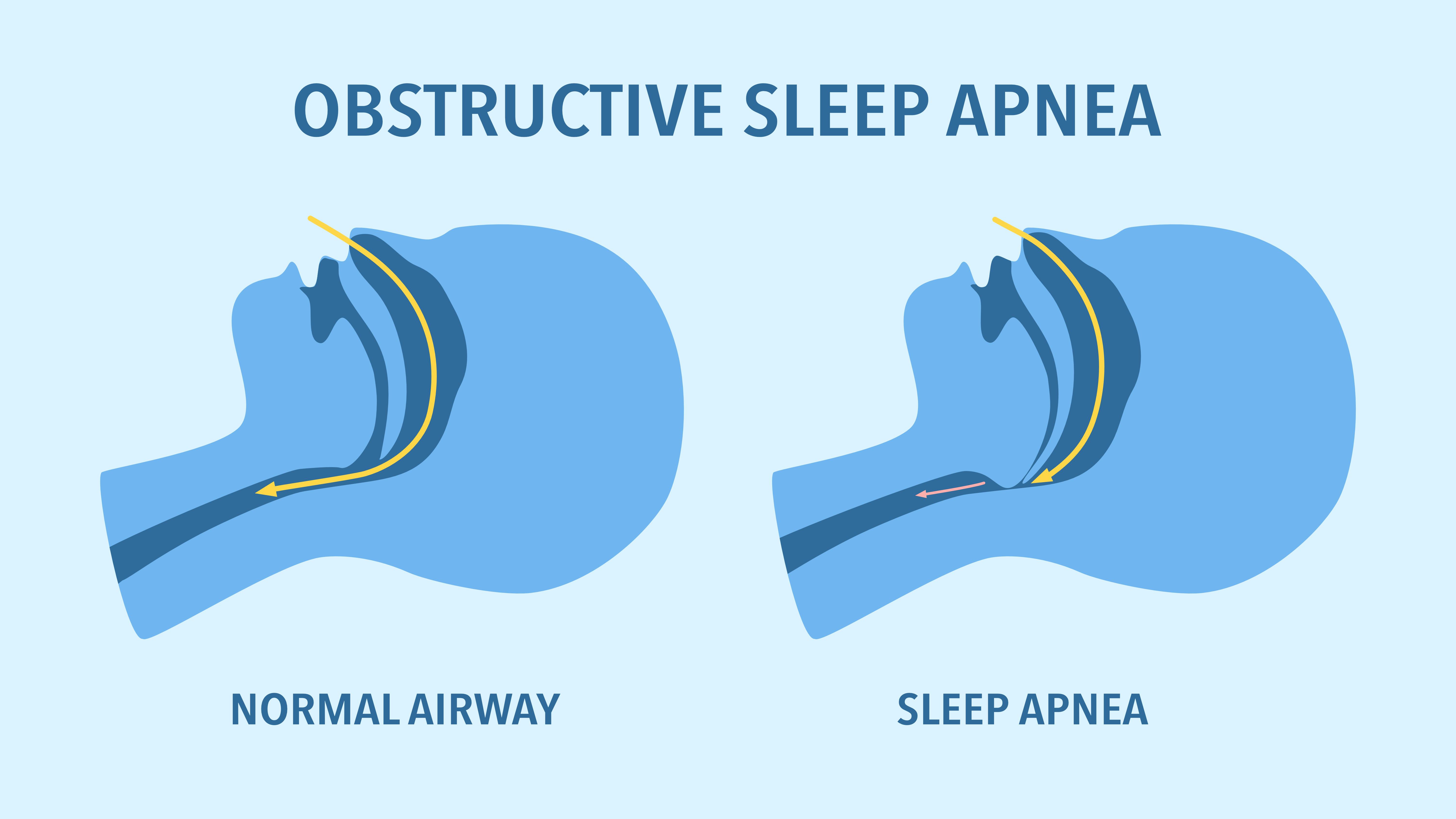 illustration of a normal airway and one of sleep apnea