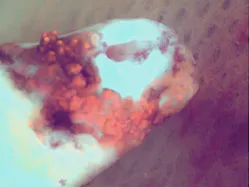 Figure 1: A tooth judged hopeless, with an associated periodontal abscess, under violet excitation. The nodular biofilm lights up red-orange.