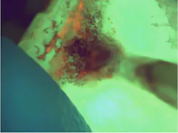 Figure 3: Calculus and tobacco tar on a tooth from a two-pack-a-day smoker, under violet excitation. The enamel fluoresces green; dark tar overlies the deposit, and within it discrete red-orange foci mark the porphyrin-producing core of the biofilm.