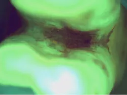 Figure 4: The same smoker’s tooth as figure 3, now at the furcation. Tar and red-fluorescing biofilm sit deep in the furcation entrance, beyond the reach of routine instrumentation.
