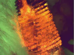 Figure 5: A failed dental implant. Red-orange fluorescing biofilm is packed into the valleys between the threads, with titanium debris visible alongside. The thread architecture is a sheltered niche for anaerobic biofilm and a geometry that a curette or scaler cannot fully reach.