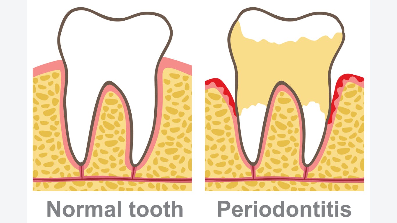 illustration of a normal tooth and one with periodontitis