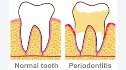 illustration of a normal tooth and one with periodontitis