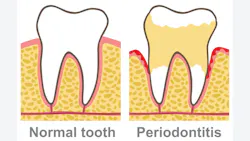 illustration of a normal tooth and one with periodontitis