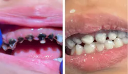 A minimally invasive transformation: Clinical appearance before and after SMART restorations.