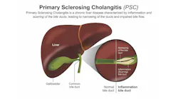 illustration of how primary sclerosing cholangitis affects the liver