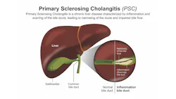 illustration of how primary sclerosing cholangitis affects the liver