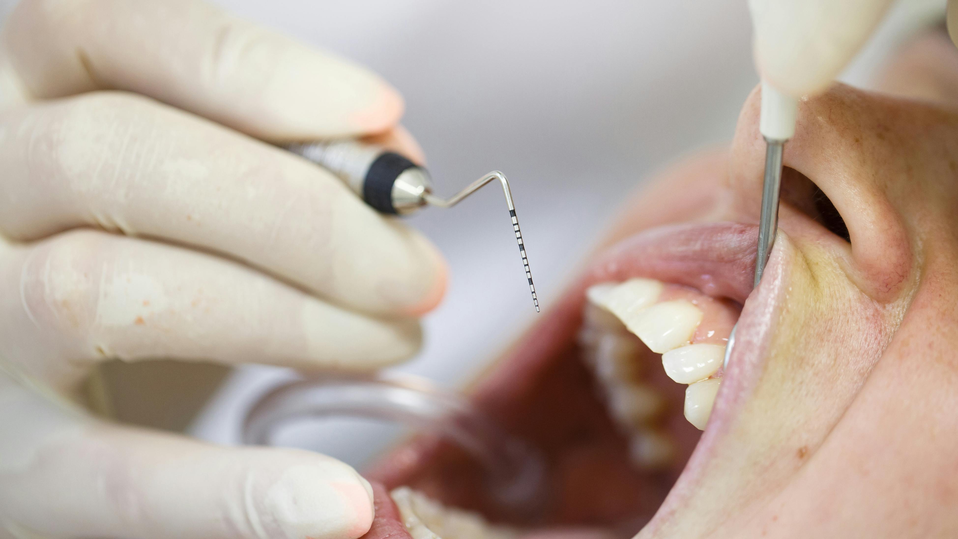 dental hygienist using a periodontal probe on a patient
