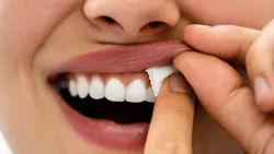 person placing a nicotine pouch on their gums