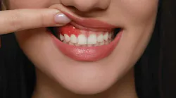 Oral inflammation